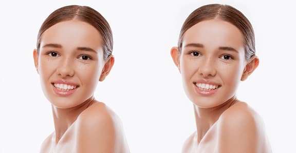 Kepçe Kulak Estetiği (Otoplasti)